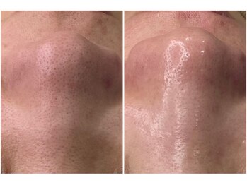 リモレア(RemoLe'a)/韓国式3D毛穴洗浄