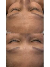 ブリア 横浜(BRILLA)/おでこのシワ改善