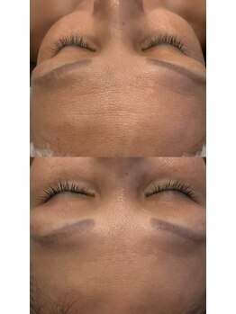 ブリア 横浜(BRILLA)/おでこのシワ改善