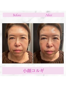 アフロディーテ 横浜(Aphrodite)/小顔コルギでスッキリ小顔に！