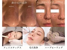 はなさくら あざみ野店の雰囲気（産毛・毛穴汚れをケアして、つるんとなめらかな素肌へ）