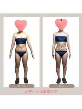 トレゾアスィス(Tresor sis)/痩身/ダイエット/筋膜リリース