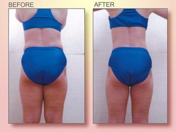 ジュリア オージェ 京橋店/ビフォーアフター(脂肪燃焼)