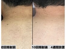 ロワ(Roi)/【全身脱毛×ボディーケア保湿】