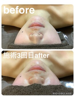 ギンザアール(GINZA R.)/小顔フェイシャル！