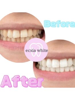 エクシアホワイトニング 仙台駅東口店/ホワイトニングビフォーアフター