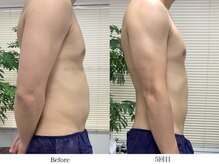 スラリ(SLARI)/【腹部　脂肪冷却】