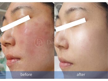 ハーシークレット(Her secret)/ダクトピール+毛穴洗浄