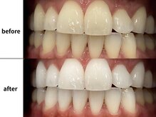 メルヴェイユ/東中野ホワイトニング