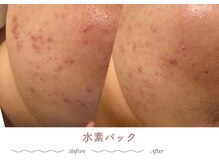 エステティックサロン シーズ/赤み・炎症肌ケア