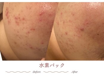 エステティックサロン シーズ/赤み・炎症肌ケア