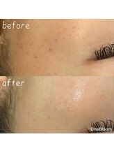 ワンブルーム(OneBloom)/出てきた！と思ったら早めに改善