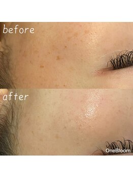 ワンブルーム(OneBloom)/出てきた!と思ったら早めに改善