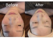 ムーンブロッサム(MoonBlossom)/肌質改善オリジナルコース90分