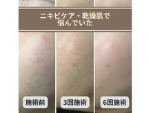 スキンベイビー 新橋(Skin Baby)/【幹細胞ハーブピーリング】