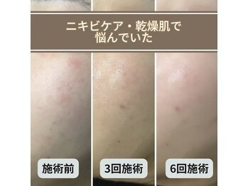 スキンベイビー 新橋(Skin Baby)/【幹細胞ハーブピーリング】