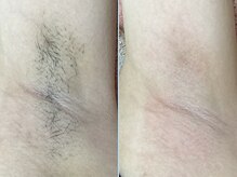 ディスイズミー シュガーリング(This is me Sugaring)