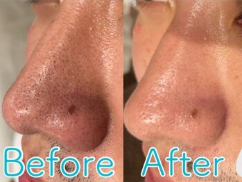 ベリッセ(Belisse)/メンズ*ハイドラ毛穴洗浄