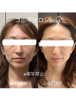 ソラ(sola*)/キュッとリフトアップ