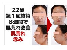 ボディアーキ 中野店(BODY ARCHI)/肌荒れ　赤み　フェイシャル