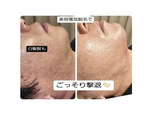 ベビースキン(baby skin)/美容電気脱毛