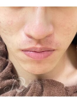 リン 長崎 大村(Rin)/after