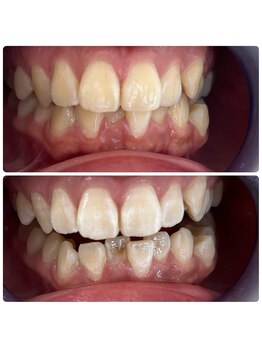 グリッター ショウナン(glitter. SHONAN)/藤沢ホワイトニングbefore/after