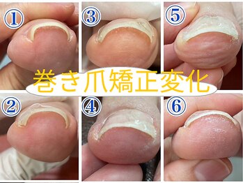 幹整体院/【巻き爪矯正】