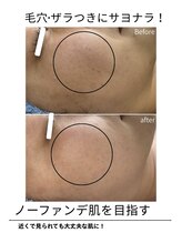 エイチケービューティーサロン(H/K beauty salon)/【ザラつき肌に】