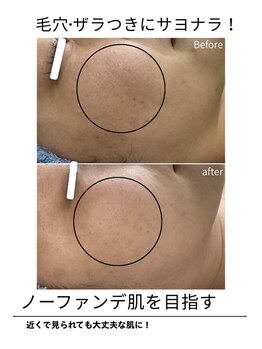 エイチケービューティーサロン(H/K beauty salon)/【ザラつき肌に】