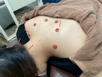 むげん整骨院鍼灸院 草津の写真/肩首が辛い方におすすめ！鍼灸施術を受けることができる癒やしの空間で心身を整えましょう♪