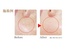 エム(M)/シミケアでキレイに!