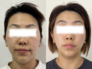 デューン 蕨店(Dune)/ほうれい線悩み【施術2ヶ月】