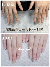 ティアラネイル 宇都宮/リプロネイル深爪矯正コース