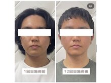ヴィーライン 恵比寿本院(VeLine)/お客様Before After/小顔効果