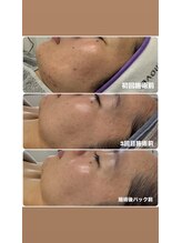 エミニー(Eminy)/ララピール