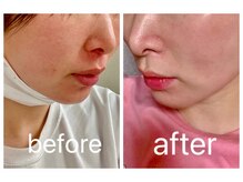 ヨサパーク カルム(YOSA PARK)/ルルオンで美肌に◎