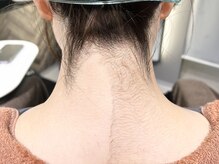 アルムボーテ 代官山 恵比寿(ARUIM Beaute)/うなじ～背中シェービング