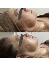 オチョビー(ocho.bee)/レモンボトルビフォーアフター