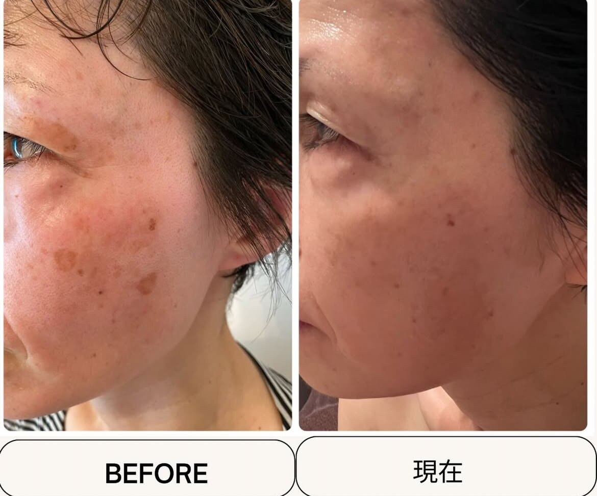 シンデレラ しみケア(Cinderella)｜ホットペッパービューティー