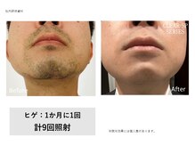 メンズ キガルモ 小山店/ひげ脱毛