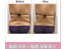 脂肪冷却で痩せたい部分に集中アプローチ♪理想のをぜひ実感