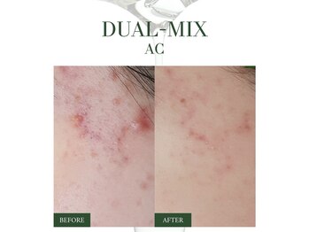 レアビューティー(Le'a beauty)/赤み、ニキビ改善