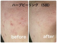 ビジュープラス 幸手店(Bijou+)の雰囲気（REVIハーブピーリング/肌質改善/ニキビ◎）