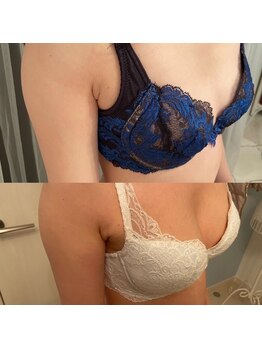 メゾン アンジュ(Maison Ange)/バストアップ症例