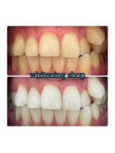 ホワイトニングショップ 所沢店/before&after美白ホワイトニング