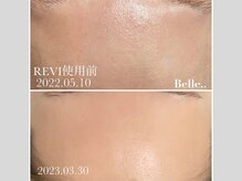 ベル(Belle..)の雰囲気（【揺らぎ肌もおまかせ】ダウンタイム無し！REVIハーブピーリング）