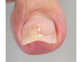 両側も一回で矯正できます