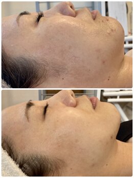 アネランスパ(Anelan Spa.)/BBLでたるみ改善&ニキビケア