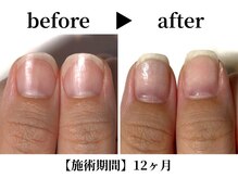 リング ザ ベル(ring the bell)/深爪スタンダードコース¥11,000